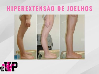 Hiperextensão de Joelhos